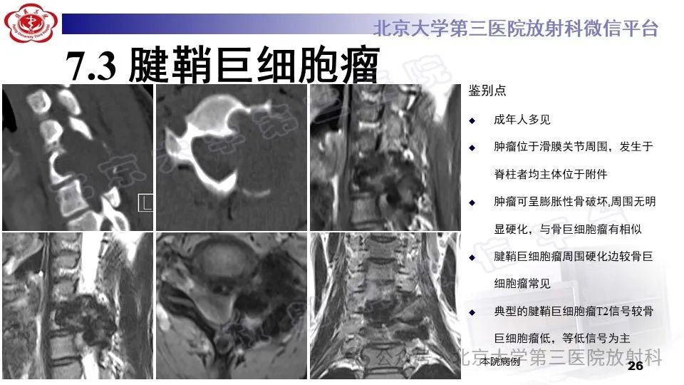 影像PPT - 【PPT】胸椎动脉瘤样骨囊肿-25