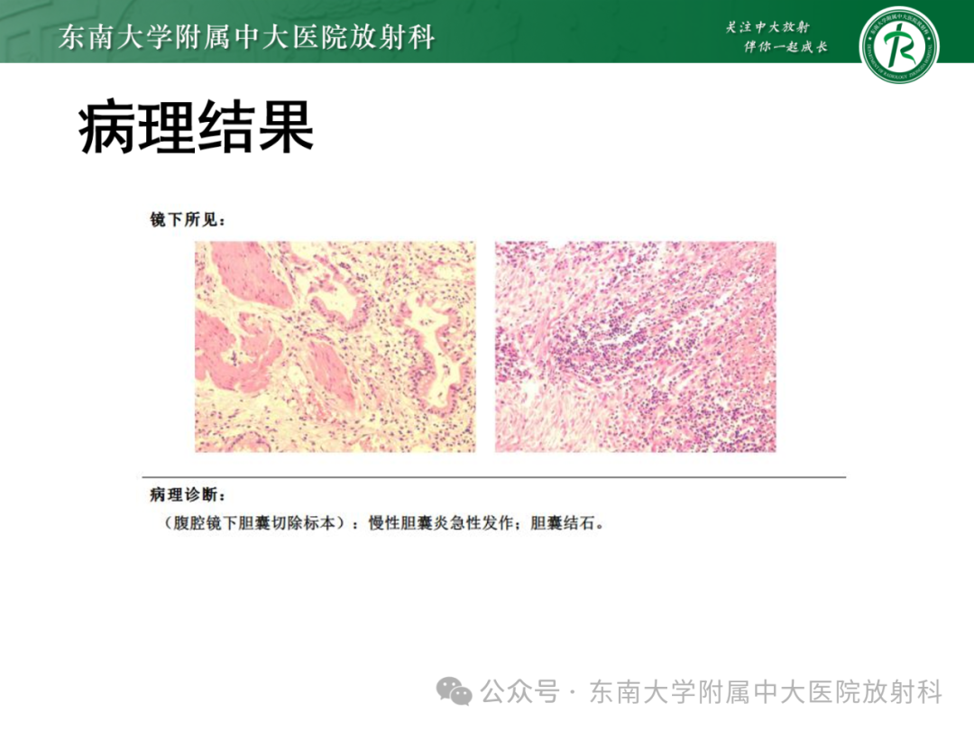 影像PPT - 【PPT】Mirizzi综合征-4