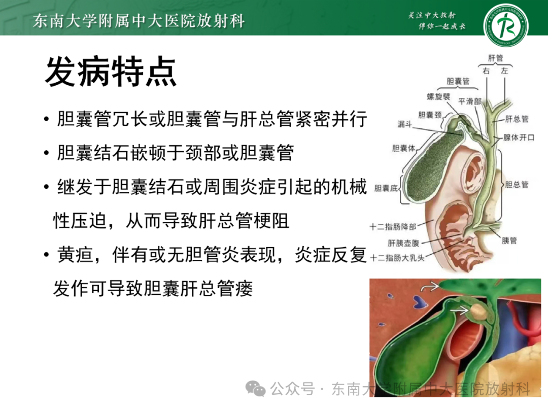 影像PPT - 【PPT】Mirizzi综合征-7