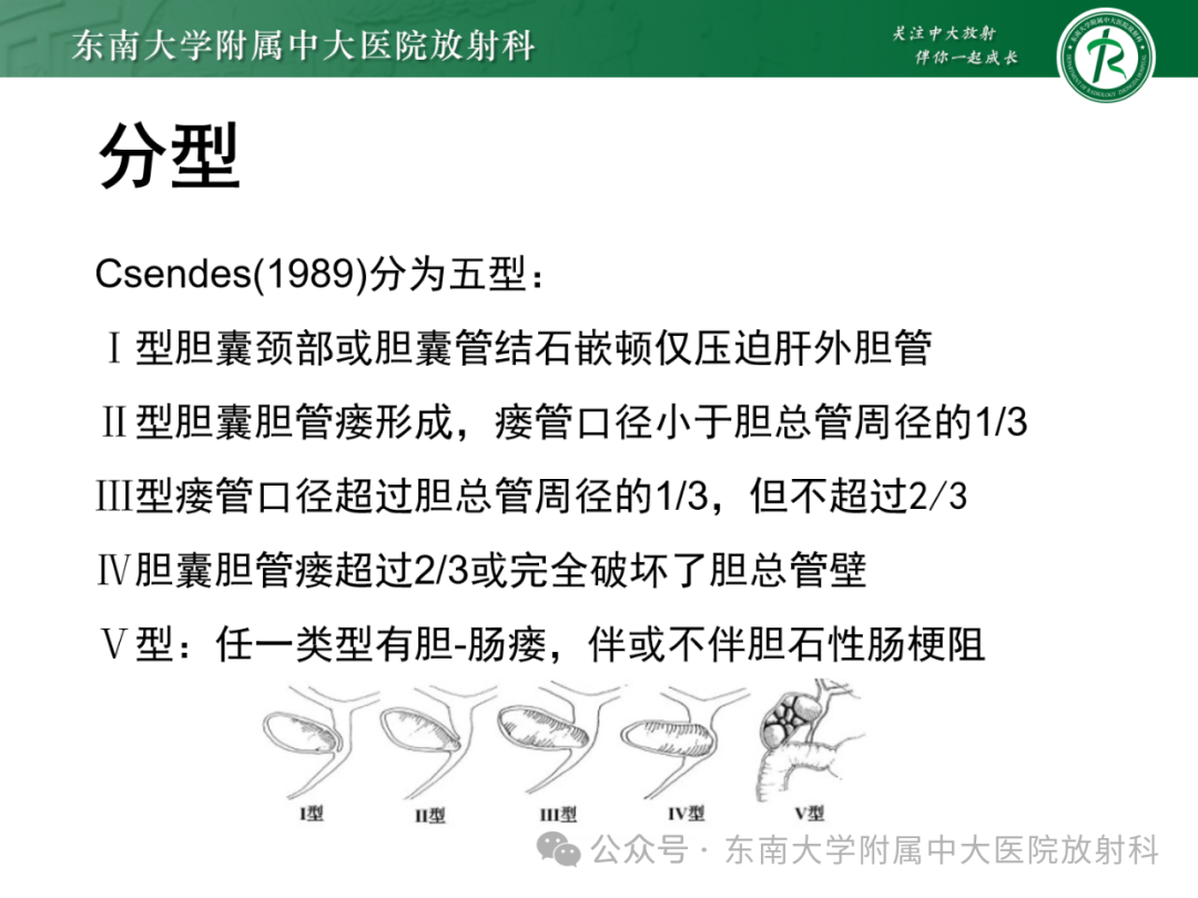 影像PPT - 【PPT】Mirizzi综合征-8