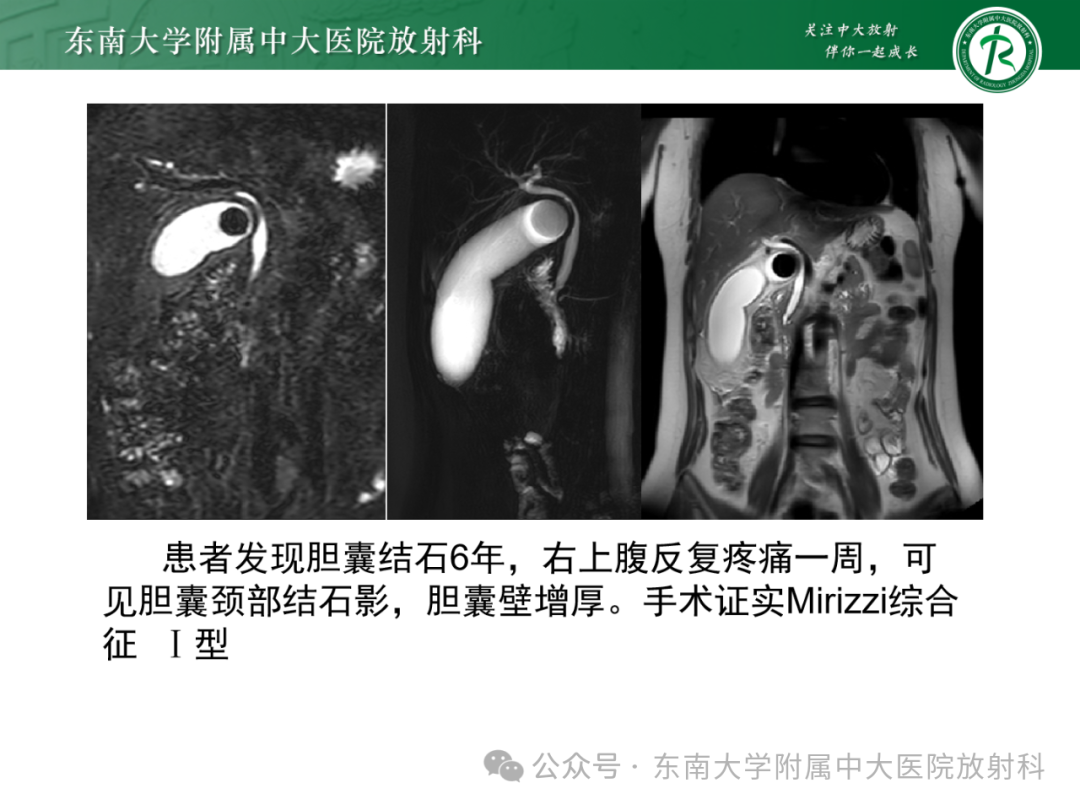 影像PPT - 【PPT】Mirizzi综合征-15
