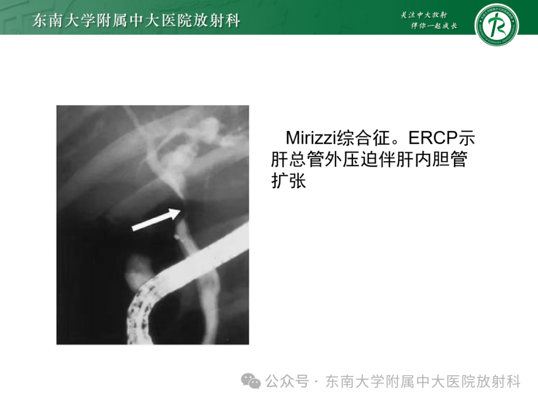 影像PPT - 【PPT】Mirizzi综合征-12