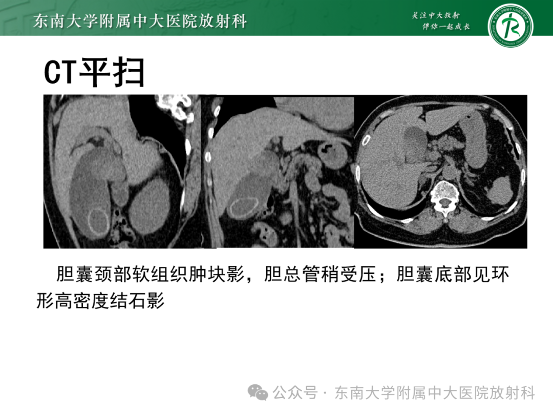影像PPT - 【PPT】Mirizzi综合征-20