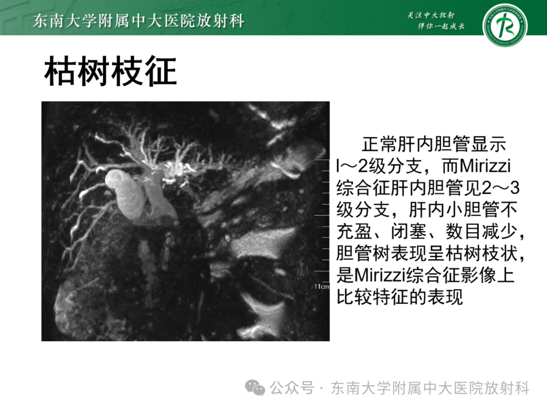 影像PPT - 【PPT】Mirizzi综合征-16