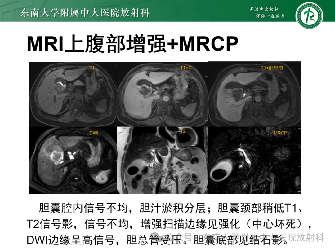 影像PPT - 【PPT】Mirizzi综合征-21