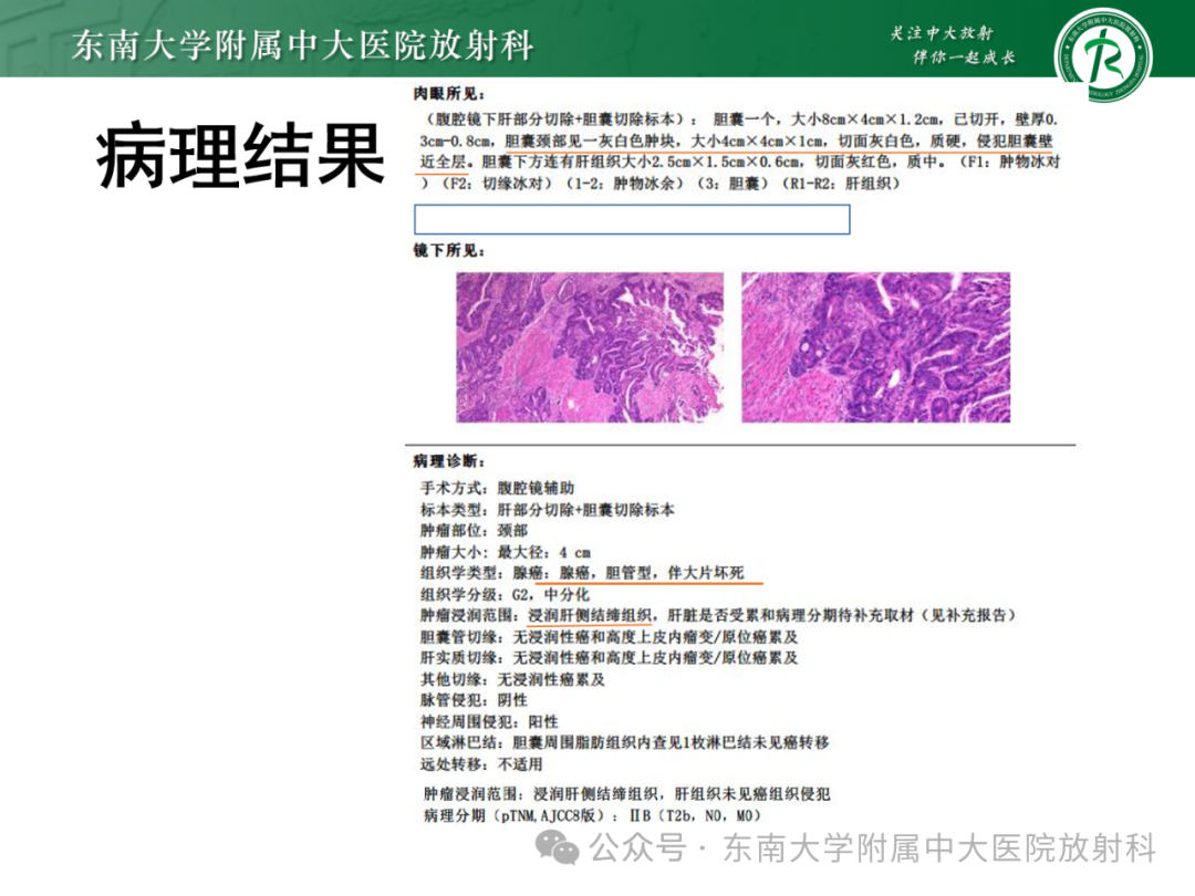 影像PPT - 【PPT】Mirizzi综合征-22