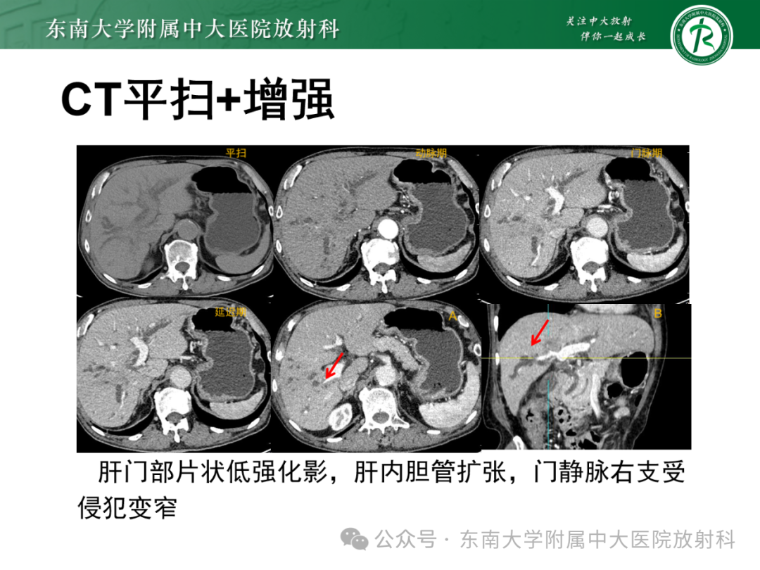 影像PPT - 【PPT】Mirizzi综合征-25