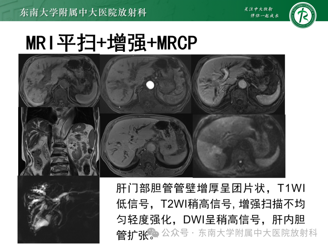 影像PPT - 【PPT】Mirizzi综合征-26