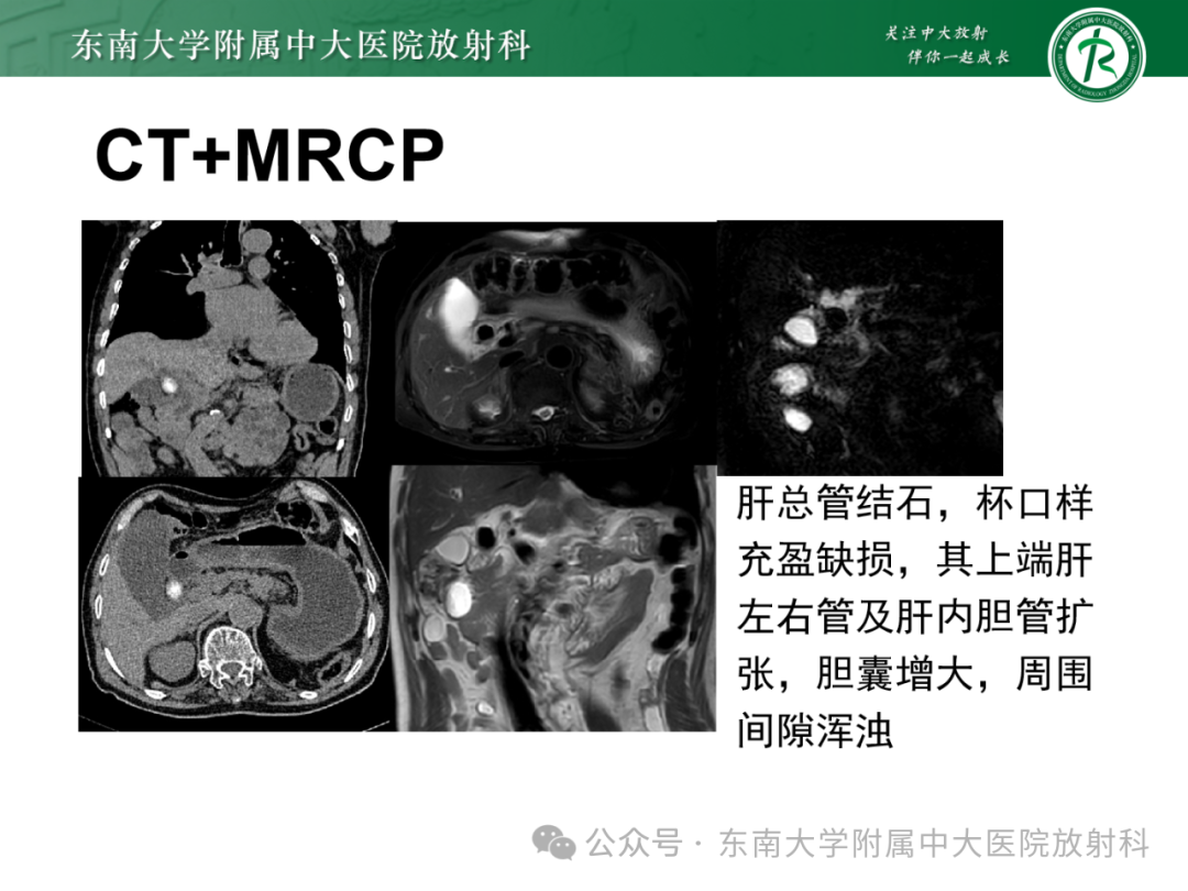 影像PPT - 【PPT】Mirizzi综合征-32