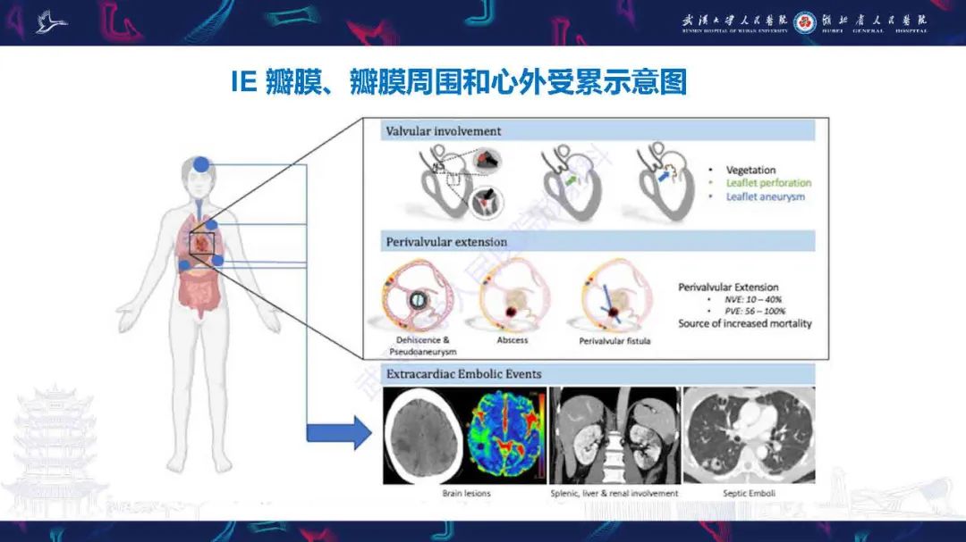 影像PPT - 【PPT】感染性心内膜炎CT诊断-15