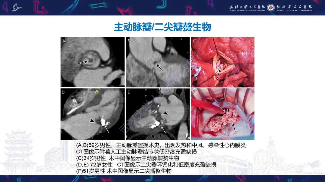 影像PPT - 【PPT】感染性心内膜炎CT诊断-18