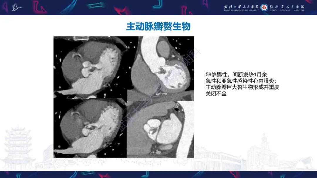 影像PPT - 【PPT】感染性心内膜炎CT诊断-19