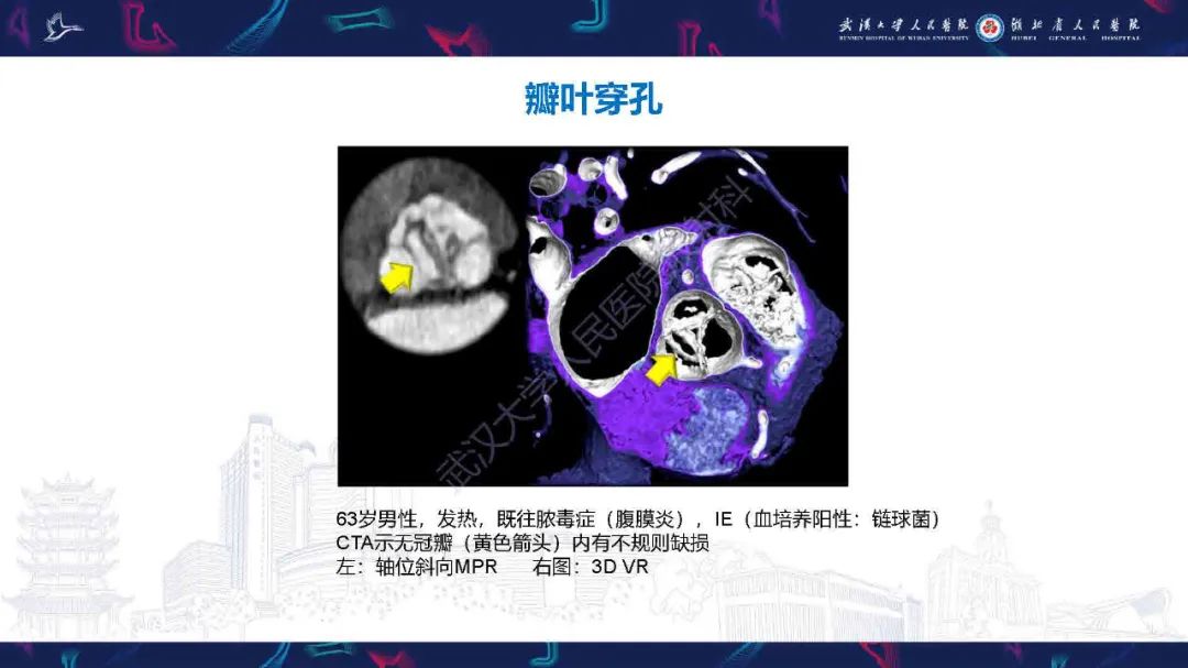 影像PPT - 【PPT】感染性心内膜炎CT诊断-20