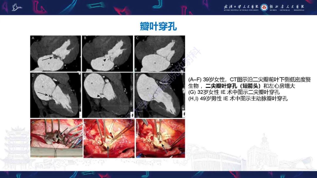 影像PPT - 【PPT】感染性心内膜炎CT诊断-21