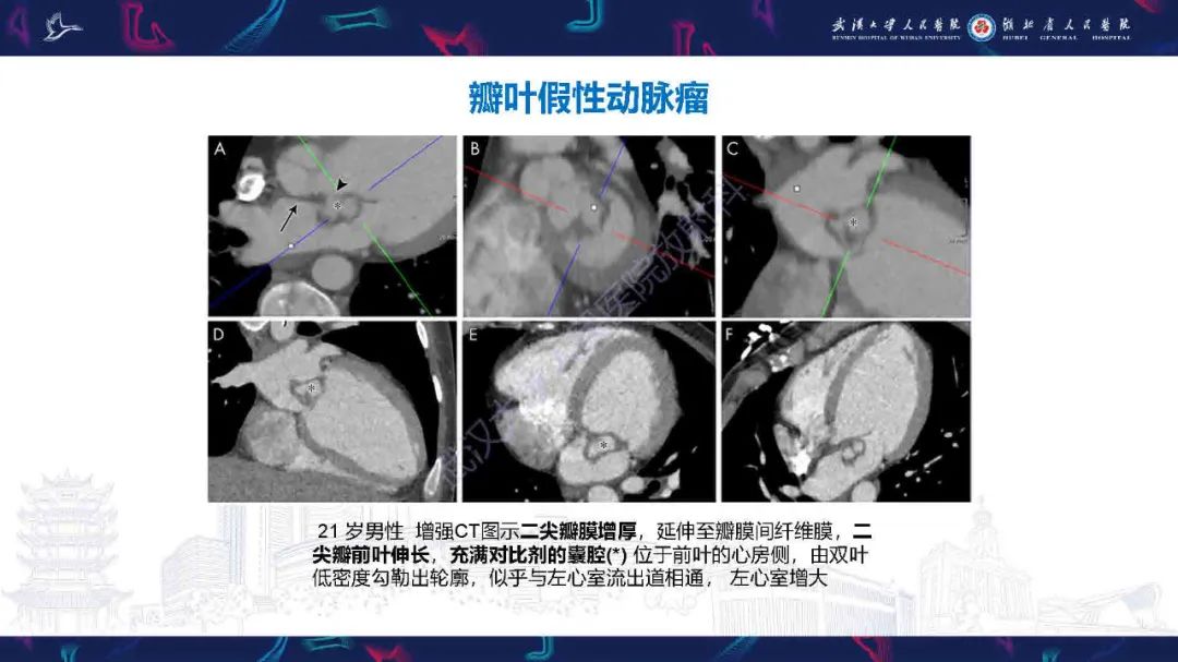 影像PPT - 【PPT】感染性心内膜炎CT诊断-22