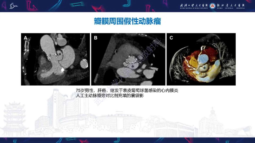 影像PPT - 【PPT】感染性心内膜炎CT诊断-24
