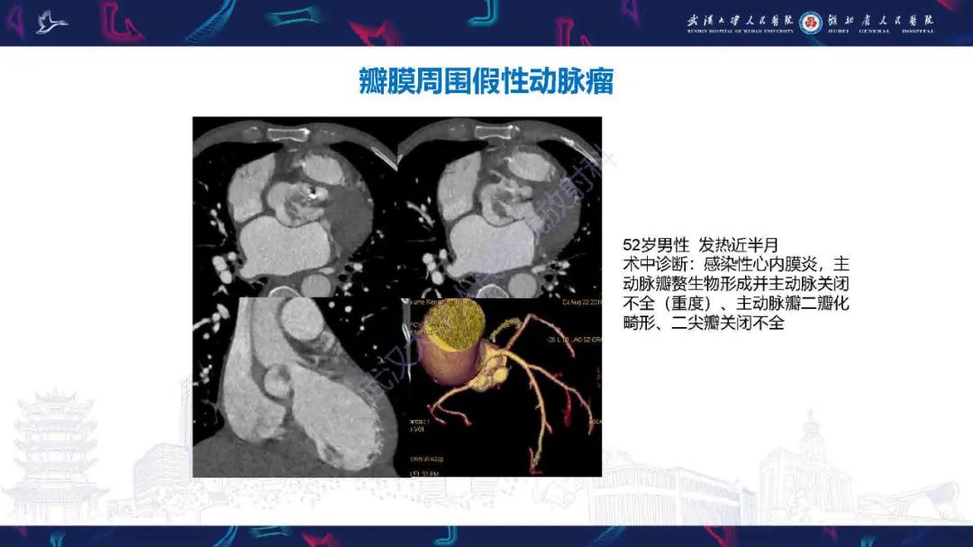 影像PPT - 【PPT】感染性心内膜炎CT诊断-25
