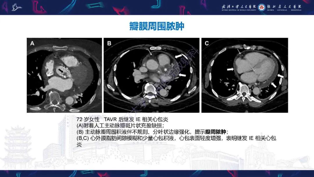 影像PPT - 【PPT】感染性心内膜炎CT诊断-26