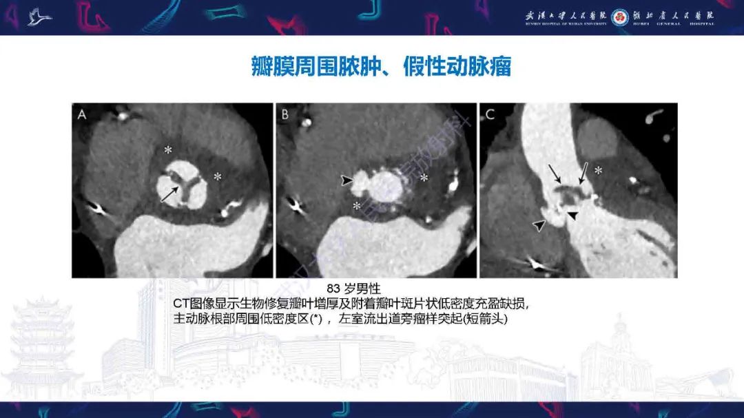 影像PPT - 【PPT】感染性心内膜炎CT诊断-27