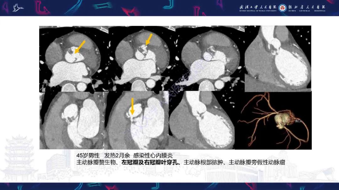 影像PPT - 【PPT】感染性心内膜炎CT诊断-28