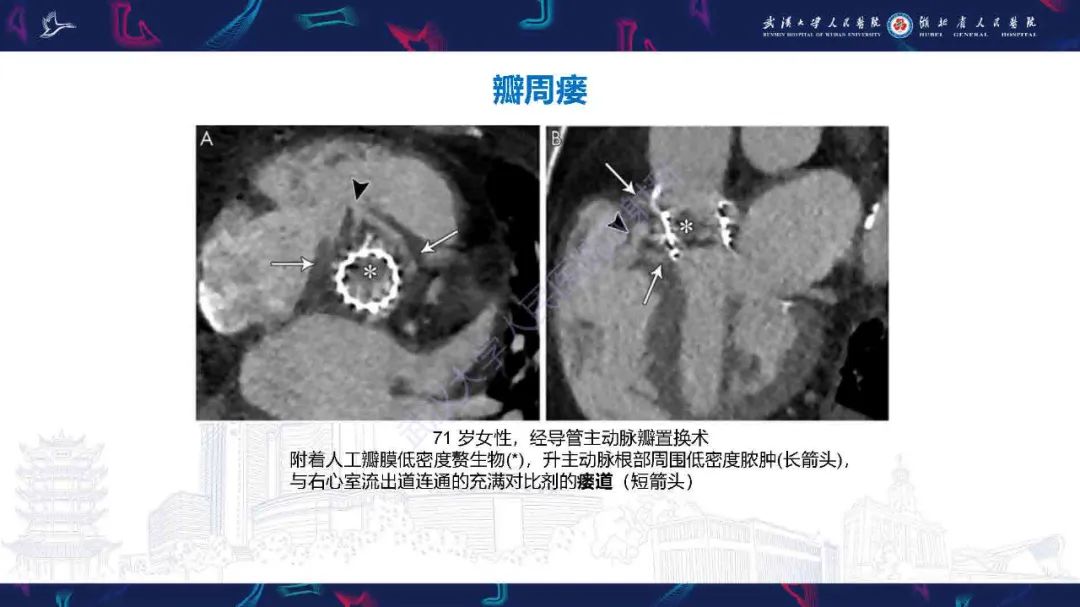 影像PPT - 【PPT】感染性心内膜炎CT诊断-29