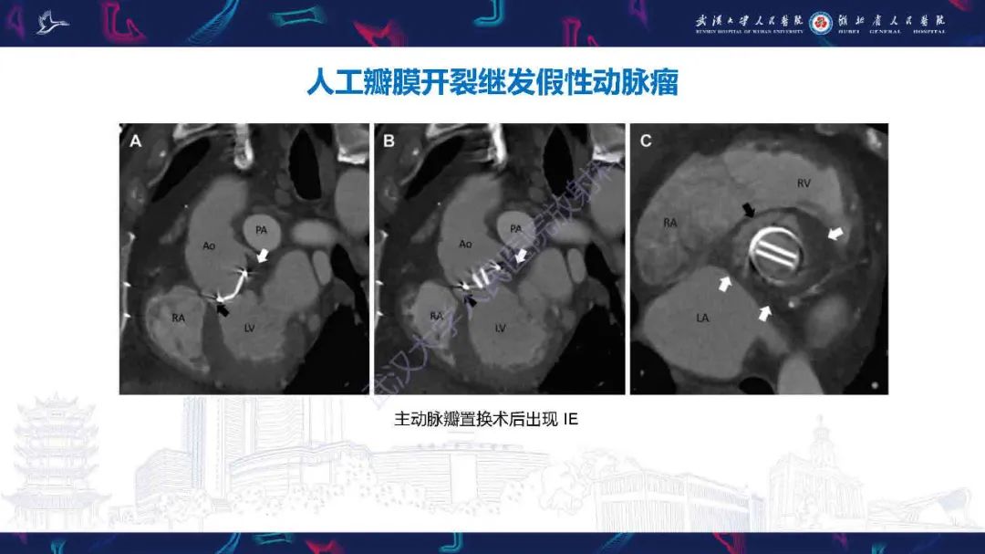 影像PPT - 【PPT】感染性心内膜炎CT诊断-30