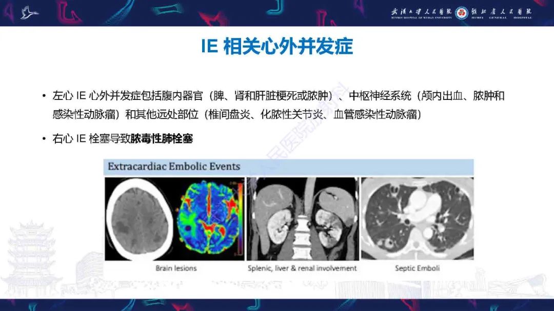 影像PPT - 【PPT】感染性心内膜炎CT诊断-31