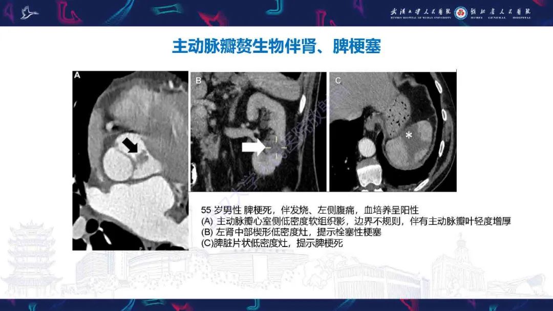 影像PPT - 【PPT】感染性心内膜炎CT诊断-32