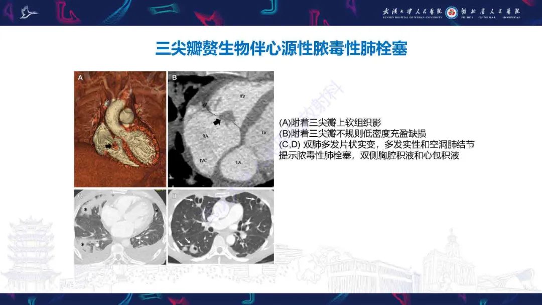 影像PPT - 【PPT】感染性心内膜炎CT诊断-33