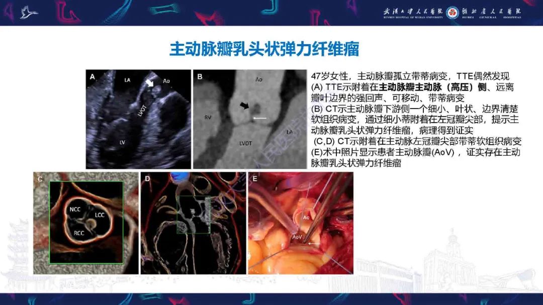 影像PPT - 【PPT】感染性心内膜炎CT诊断-36