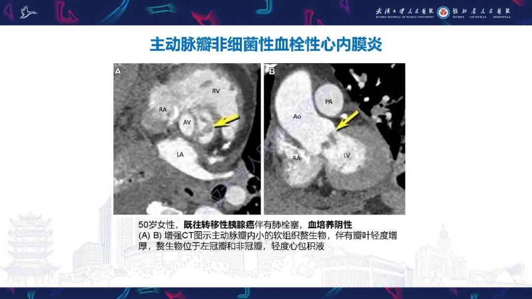 影像PPT - 【PPT】感染性心内膜炎CT诊断-38