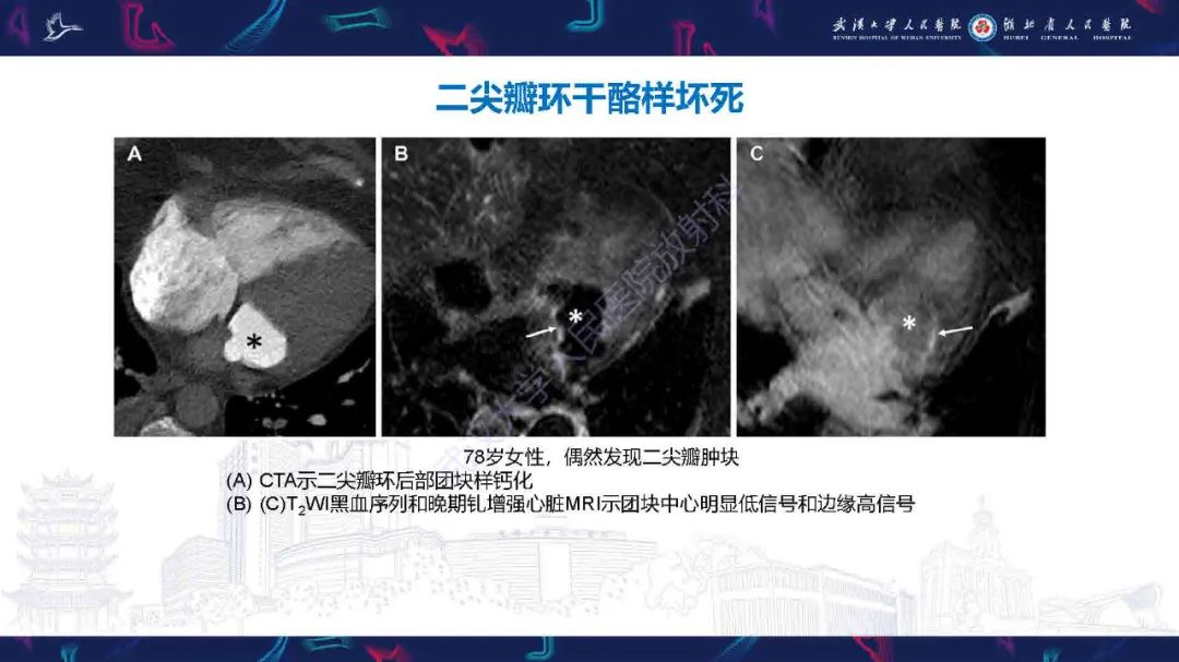 影像PPT - 【PPT】感染性心内膜炎CT诊断-40