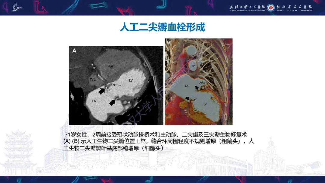 影像PPT - 【PPT】感染性心内膜炎CT诊断-42