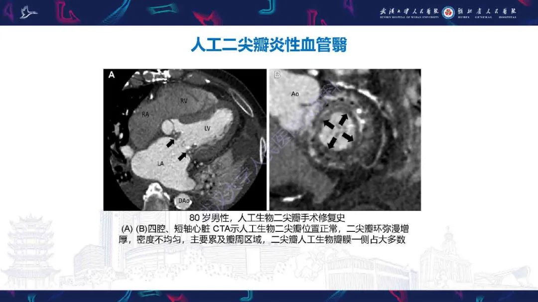 影像PPT - 【PPT】感染性心内膜炎CT诊断-44