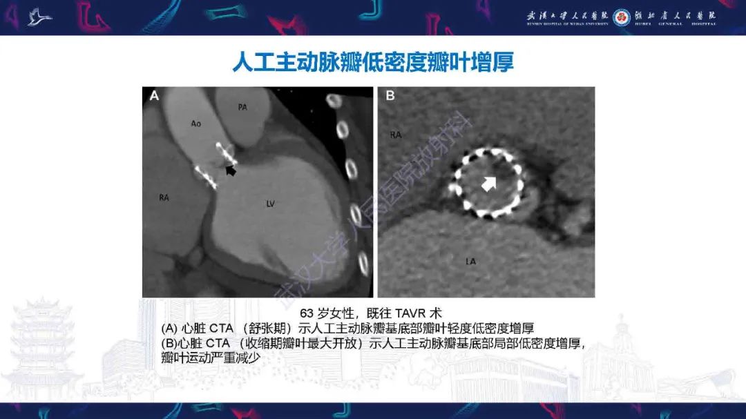 影像PPT - 【PPT】感染性心内膜炎CT诊断-46