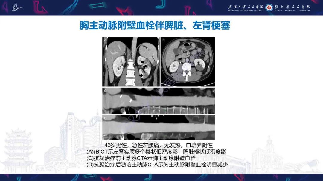 影像PPT - 【PPT】感染性心内膜炎CT诊断-50