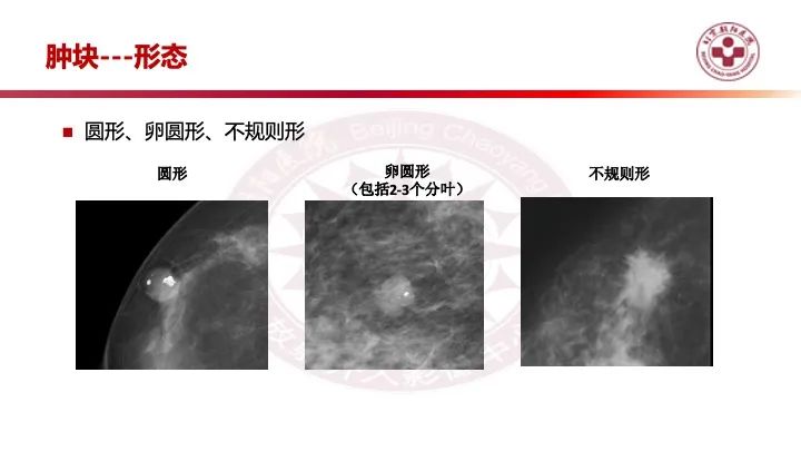 影像PPT - 【PPT】乳腺x线征象解读-8
