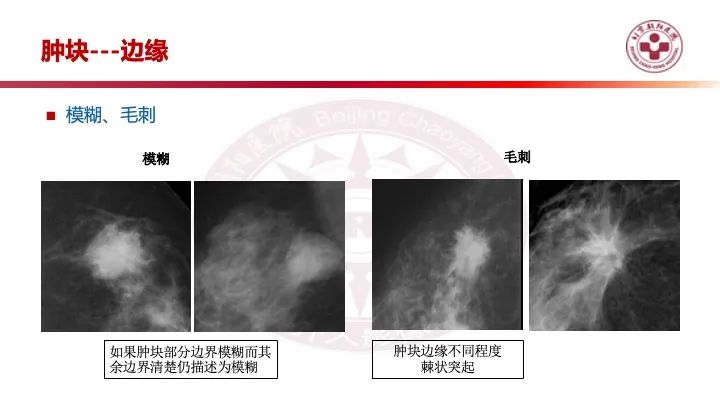 影像PPT - 【PPT】乳腺x线征象解读-10