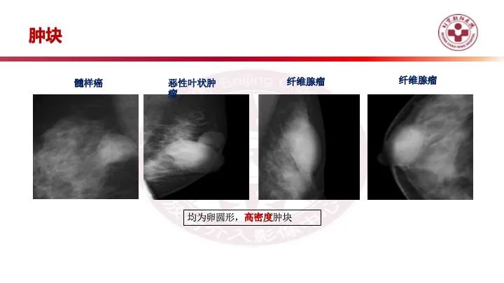 影像PPT - 【PPT】乳腺x线征象解读-14