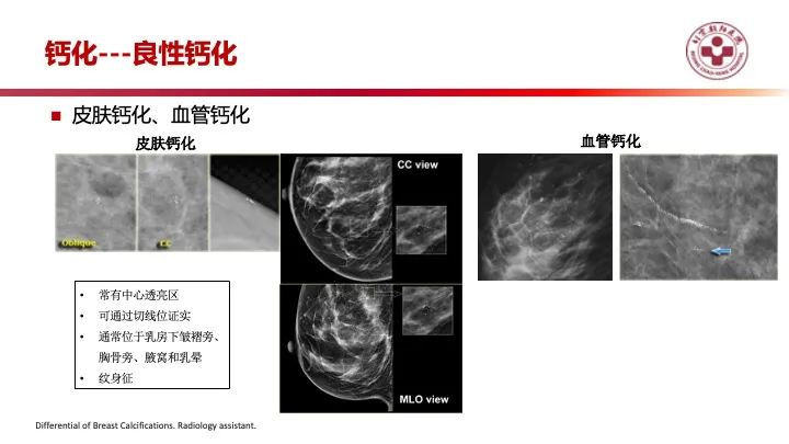 影像PPT - 【PPT】乳腺x线征象解读-17