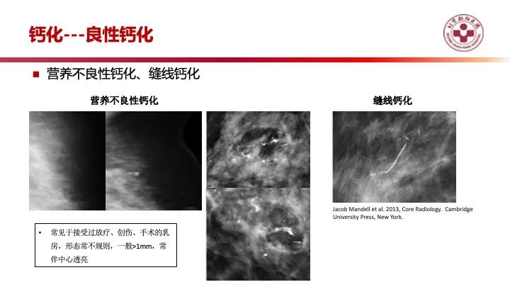影像PPT - 【PPT】乳腺x线征象解读-21