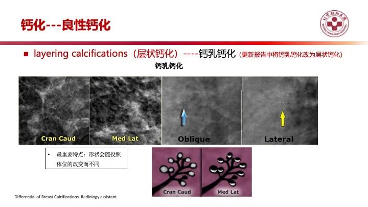 影像PPT - 【PPT】乳腺x线征象解读-20