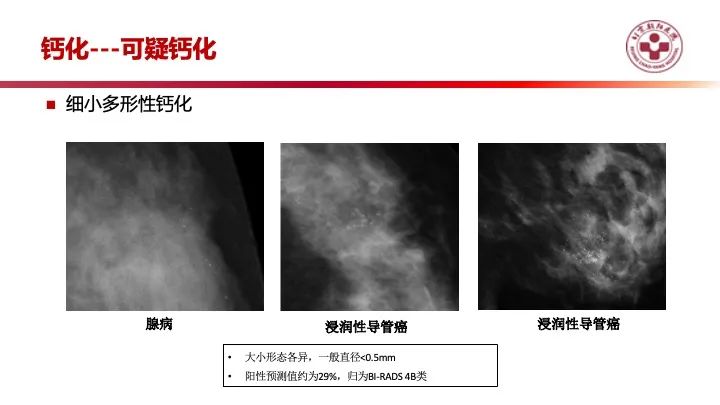 影像PPT - 【PPT】乳腺x线征象解读-24