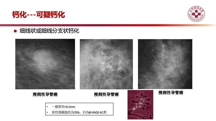 影像PPT - 【PPT】乳腺x线征象解读-25