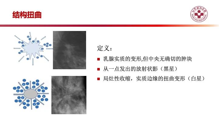 影像PPT - 【PPT】乳腺x线征象解读-29