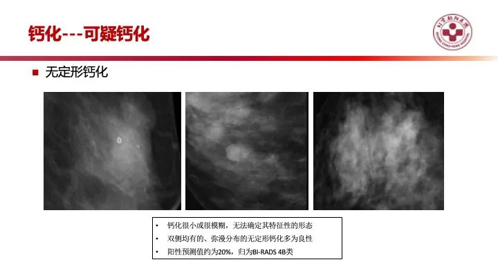 影像PPT - 【PPT】乳腺x线征象解读-22