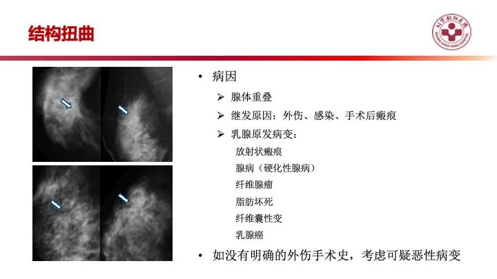 影像PPT - 【PPT】乳腺x线征象解读-30