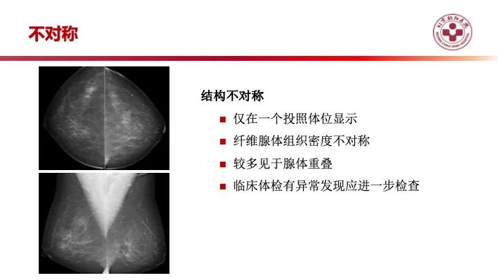 影像PPT - 【PPT】乳腺x线征象解读-33