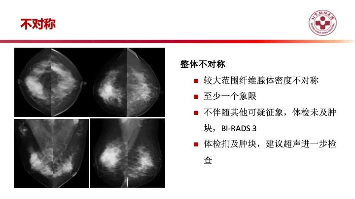 影像PPT - 【PPT】乳腺x线征象解读-35