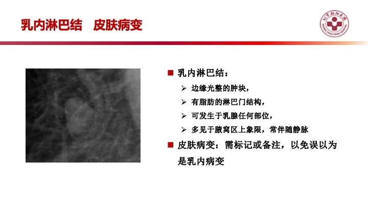 影像PPT - 【PPT】乳腺x线征象解读-38
